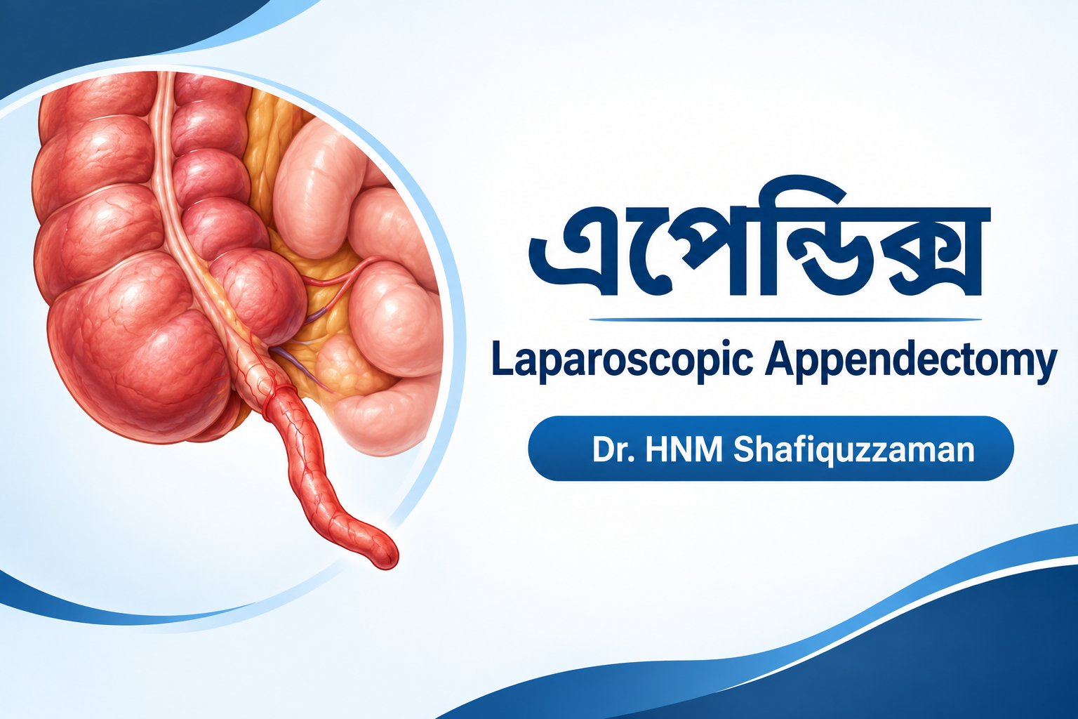 এপেন্ডিক্স অপারেশন রাজশাহী Laparoscopic Appendectomy Dr. HNM Shafiquzzaman